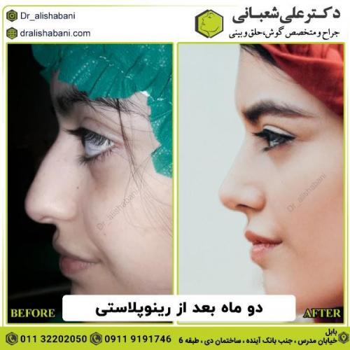 جراحی-بینی-136