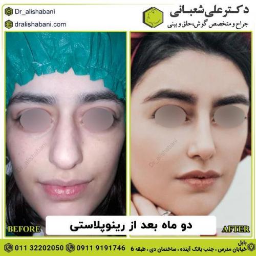 جراحی-بینی-137
