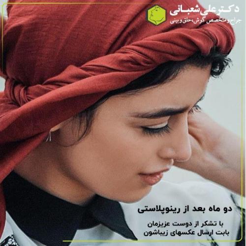 جراحی-بینی-138