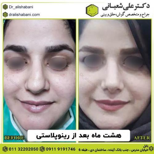 جراحی-بینی-142