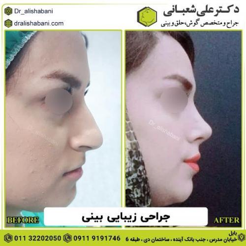 جراحی-بینی-147