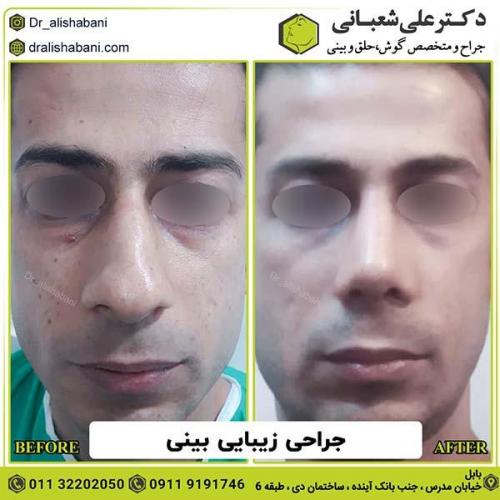 جراحی-بینی-151