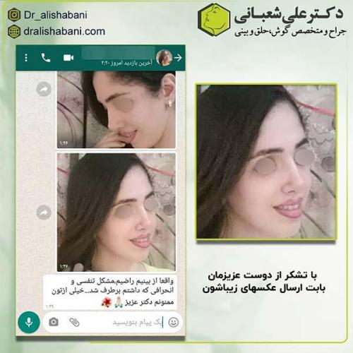 جراحی-بینی-156