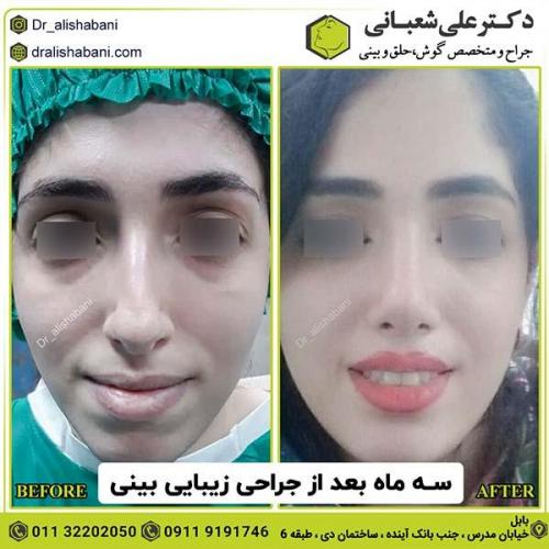 جراحی-بینی-157