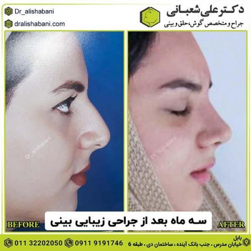 جراحی-بینی-161
