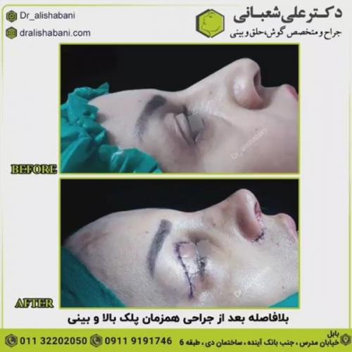 جراحی-بینی-165