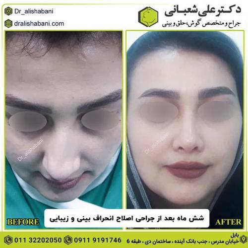 جراحی-بینی-167