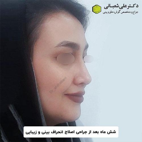 جراحی-بینی-171