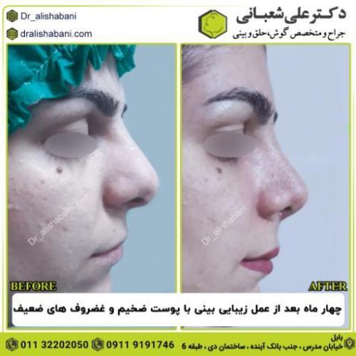 جراحی-بینی-175