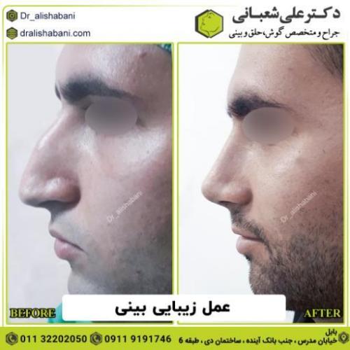 جراحی-بینی-177