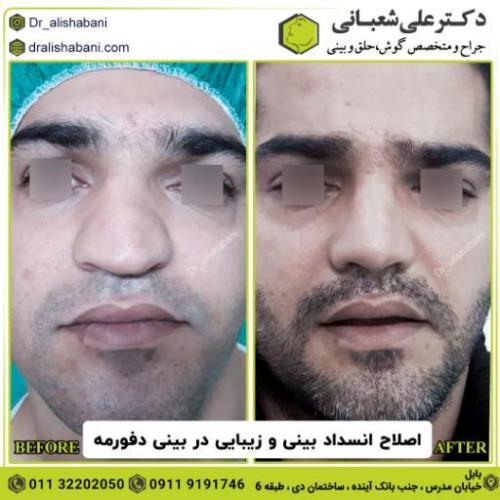 جراحی-بینی-180