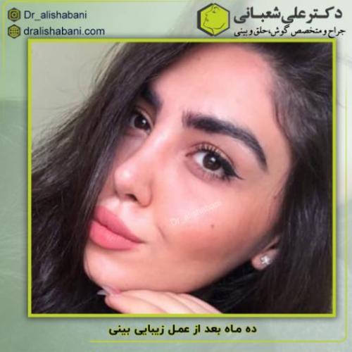 جراحی-بینی-181