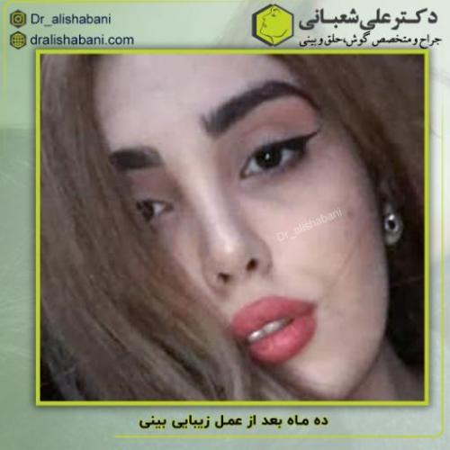 جراحی-بینی-182