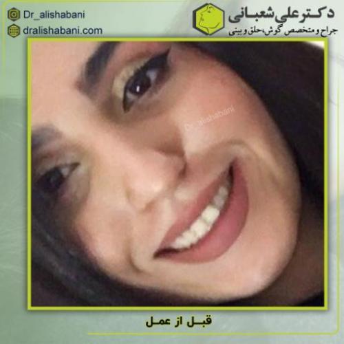 جراحی-بینی-183