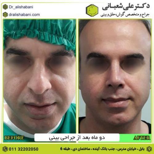 جراحی-بینی-185