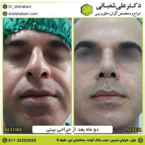 جراحی-بینی-186
