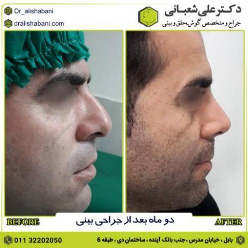 جراحی-بینی-206