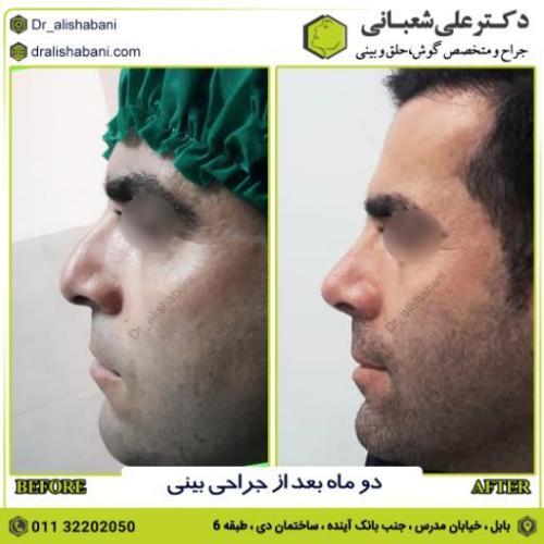 جراحی-بینی-207