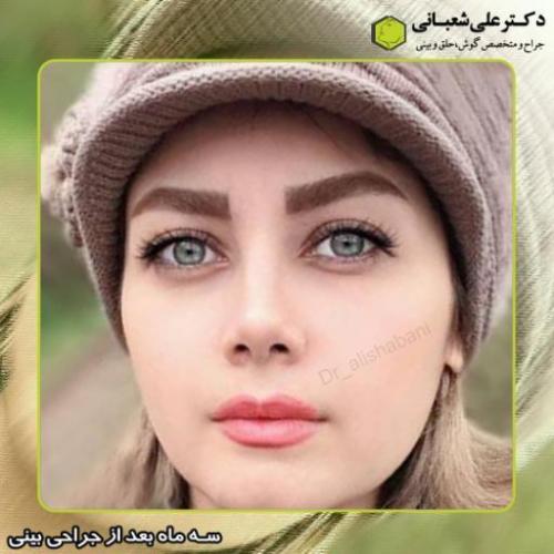 جراحی-بینی-211