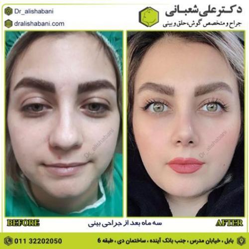 جراحی-بینی-212