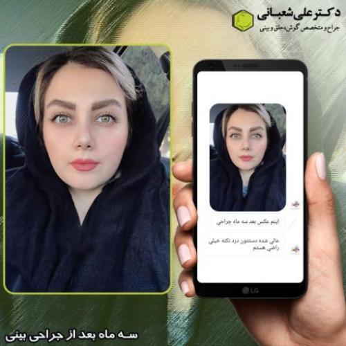 جراحی-بینی-213