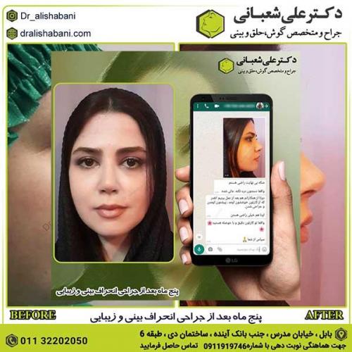 جراحی-بینی-220