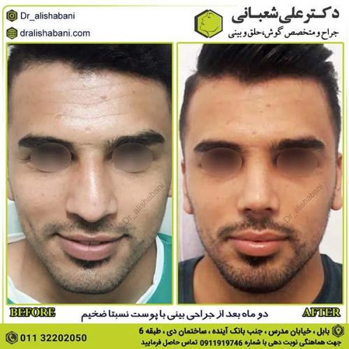 جراحی-بینی-223