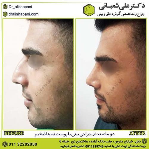 جراحی-بینی-224