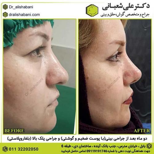 جراحی-بینی-231