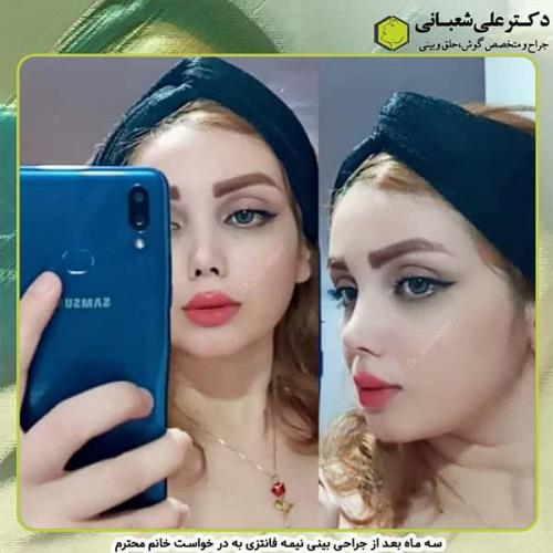 جراحی-بینی-233
