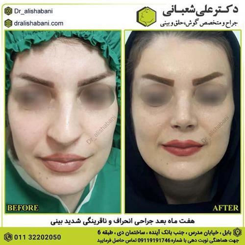 جراحی-بینی-238