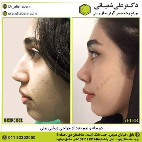 جراحی-بینی-243