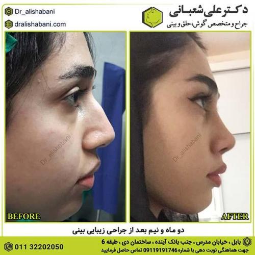 جراحی-بینی-244