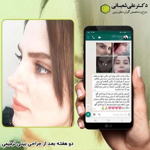جراحی-بینی-246