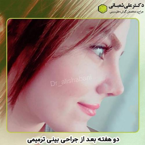 جراحی-بینی-249