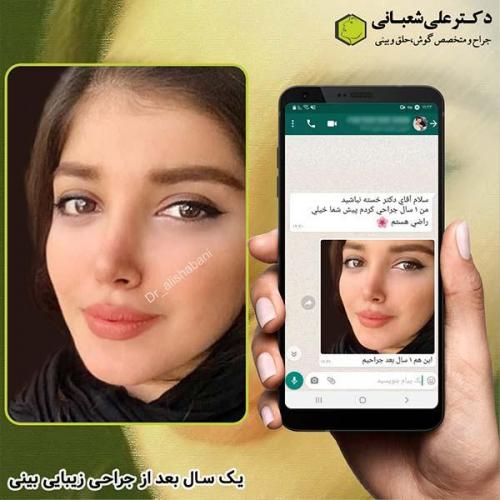 جراحی-بینی-251