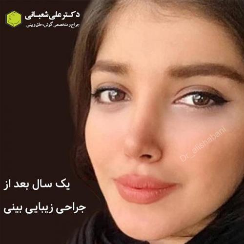 جراحی-بینی-252
