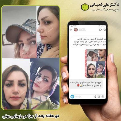جراحی-بینی-254