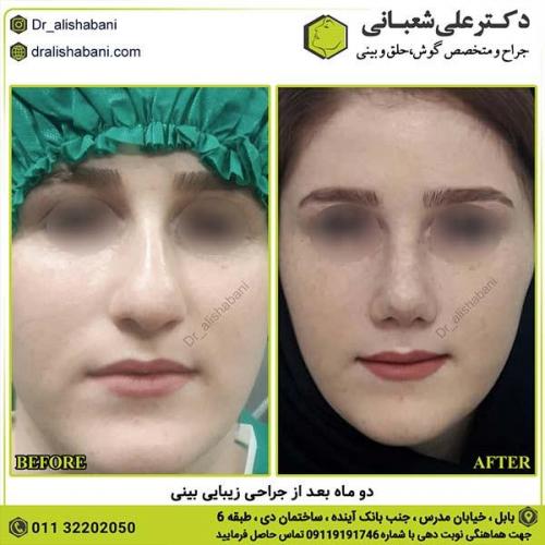 جراحی-بینی-255
