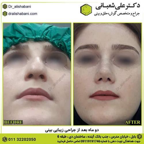 جراحی-بینی-258