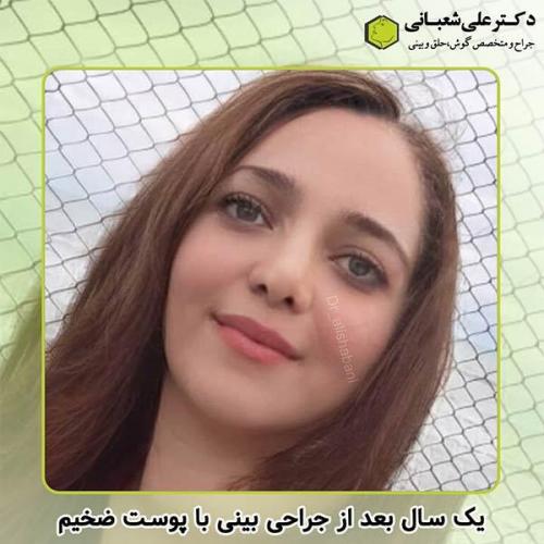 جراحی-بینی-259