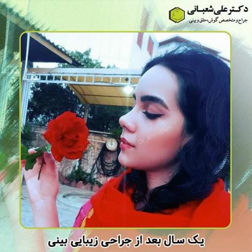 جراحی-بینی-264