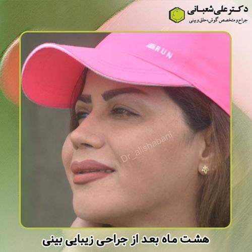 جراحی-بینی-266