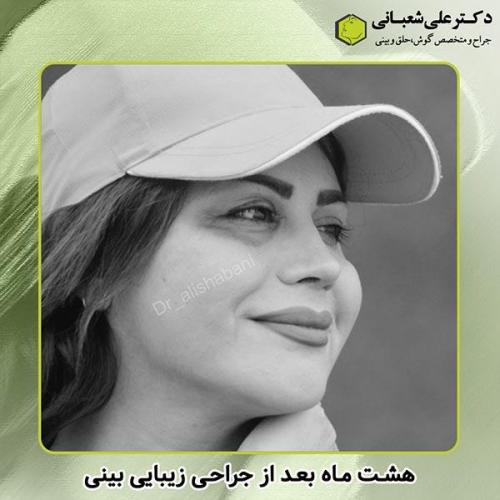 جراحی-بینی-267