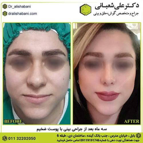جراحی-بینی-268