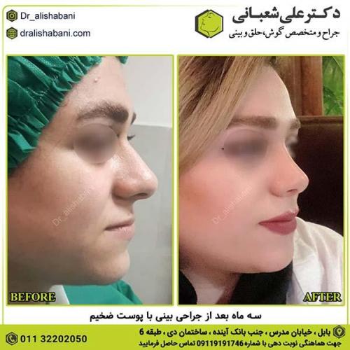 جراحی-بینی-270