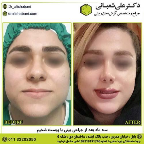 جراحی-بینی-271