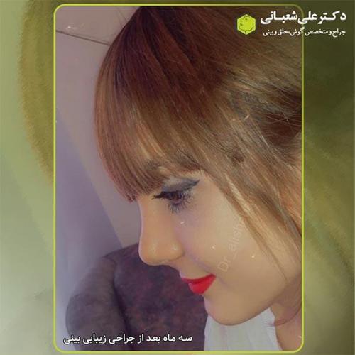 جراحی-بینی-276