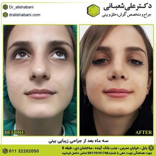 جراحی-بینی-279