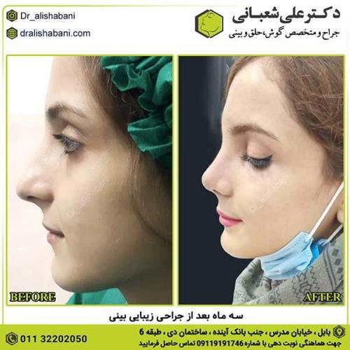 جراحی-بینی-280